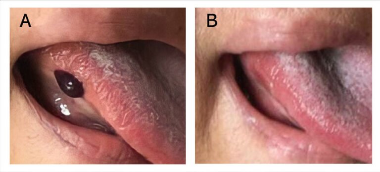 تاول خونی زیر زبان نشانه چیست؟ + علت