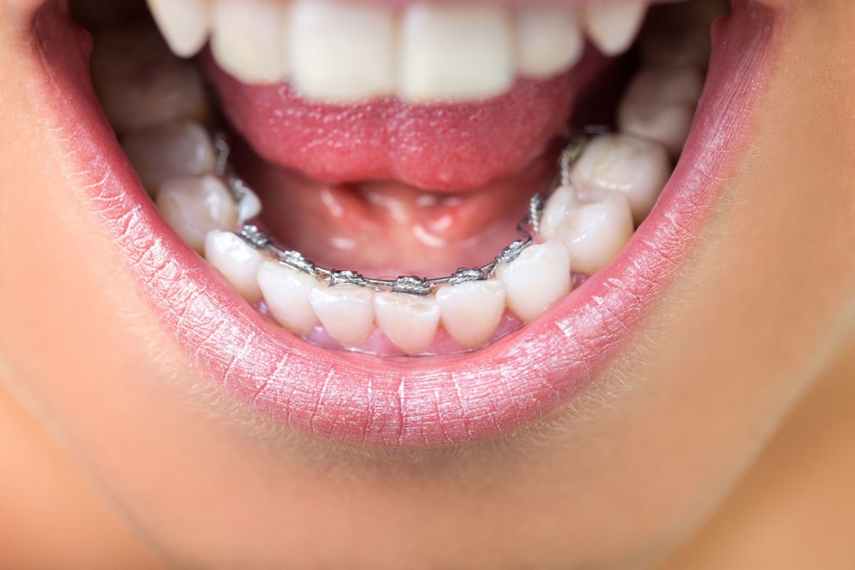 تفاوت دست دندان بالا و پایین در طراحی و کاربرد